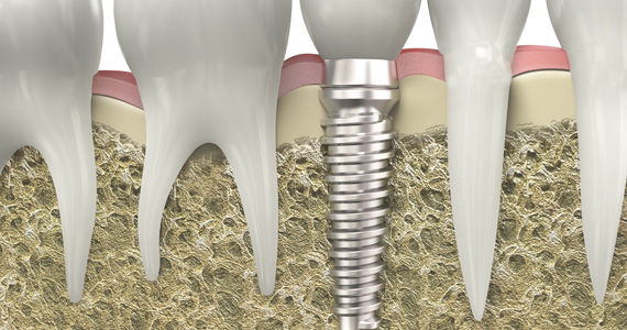 Implantodontia